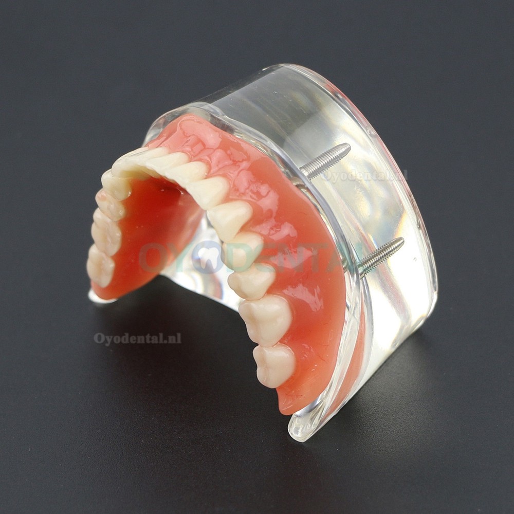 Demo-onderzoek tandheelkundige onderste tanden Model 6002 02 Overdenture Inferior 4 implantaten